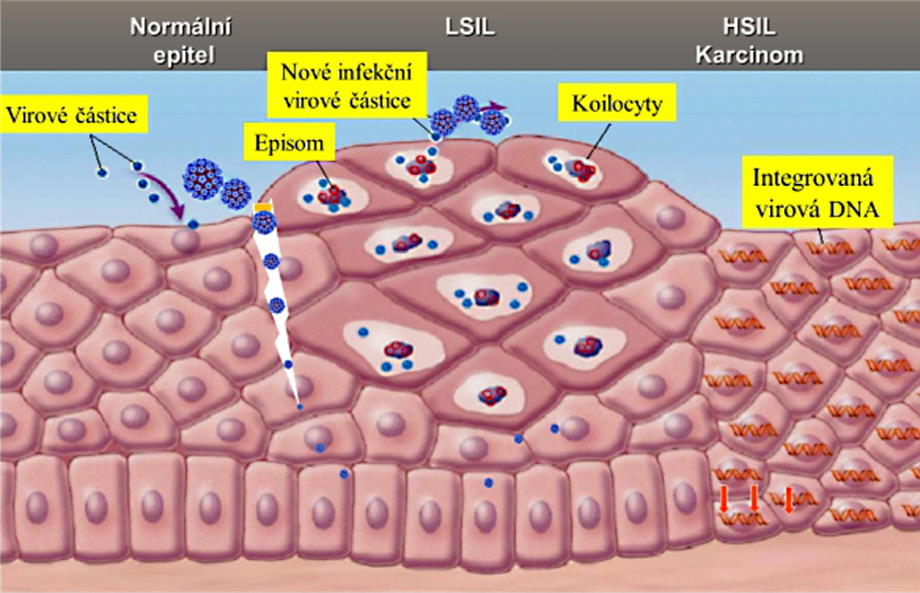 průběh HPV infekce